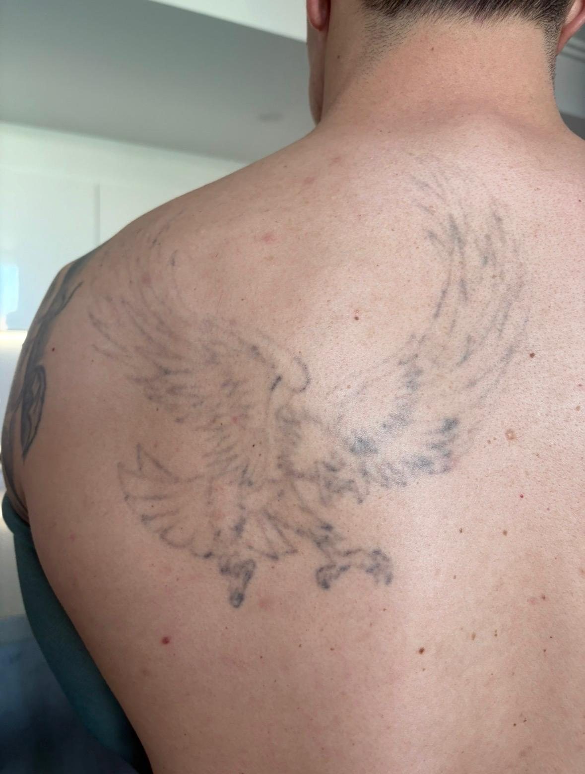 Eagle tattoo on the upper back after 3 laser sessions