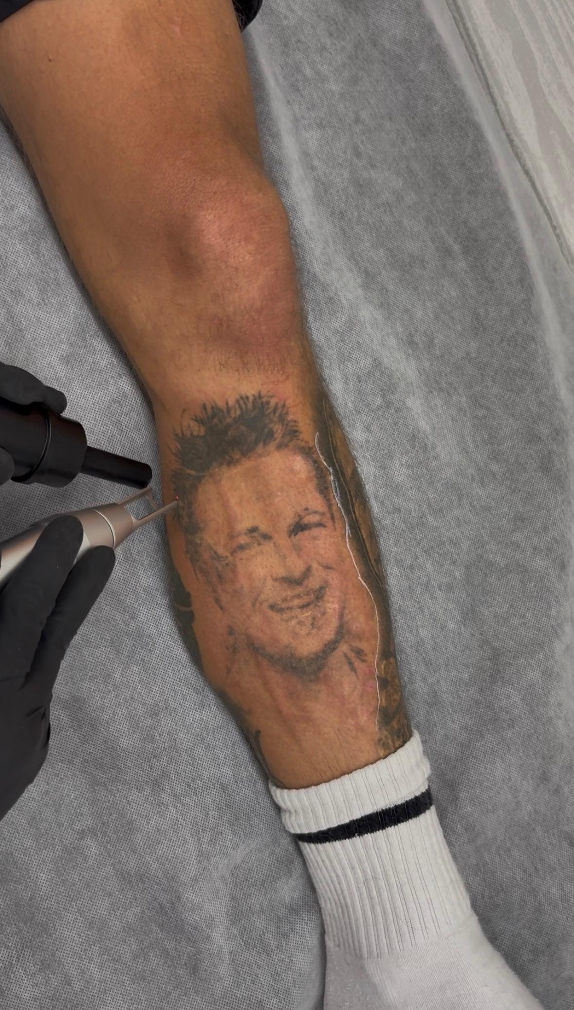 Laser treatment and cooling on a lower leg portrait tattoo